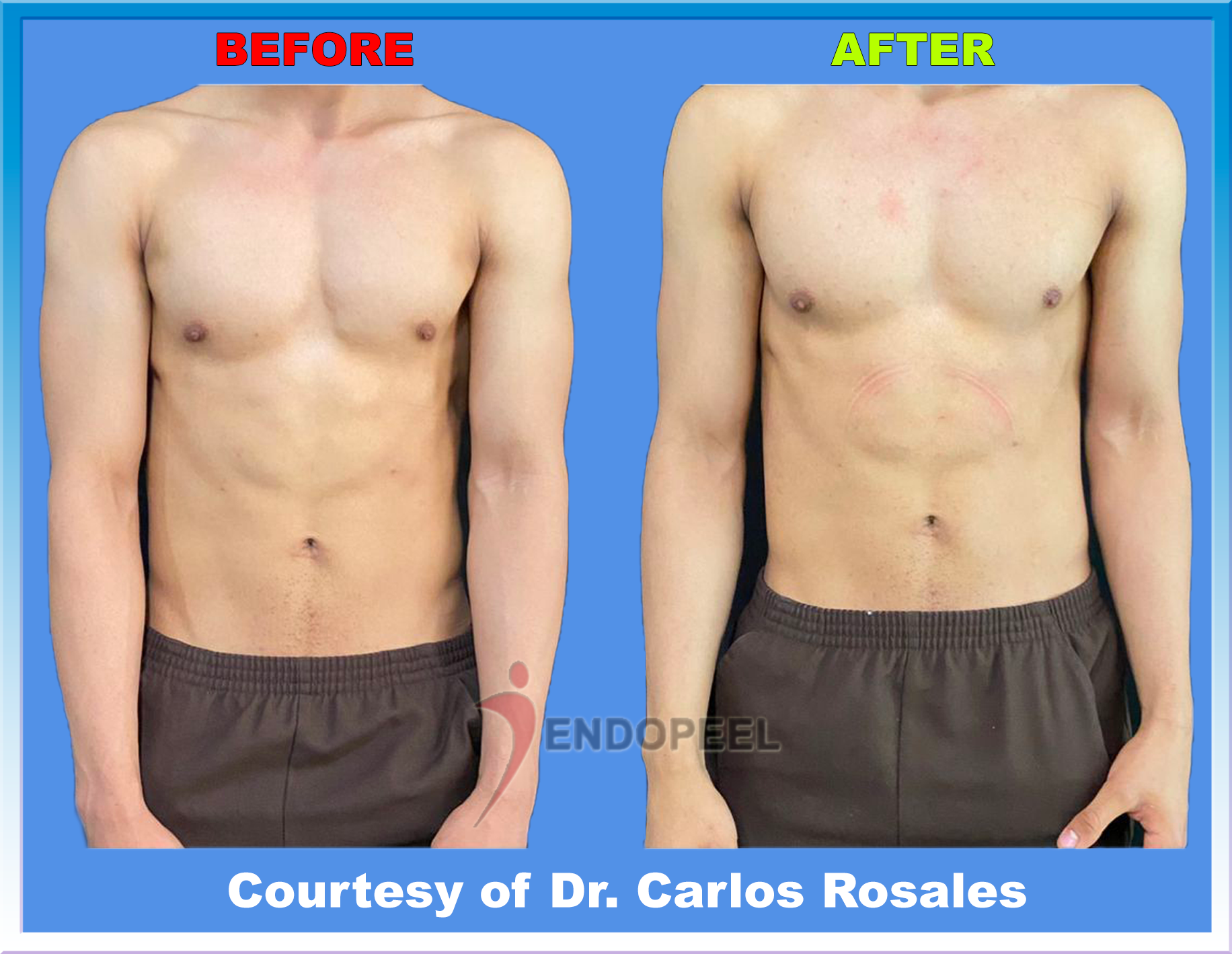 immediate 6 packs endopeel by Dr.Rosales front view in 2023