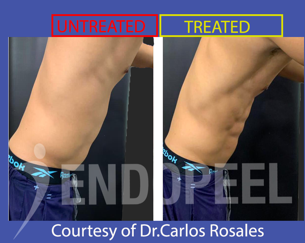 immediate 6 packs endopeel by Dr.Rosales profile view