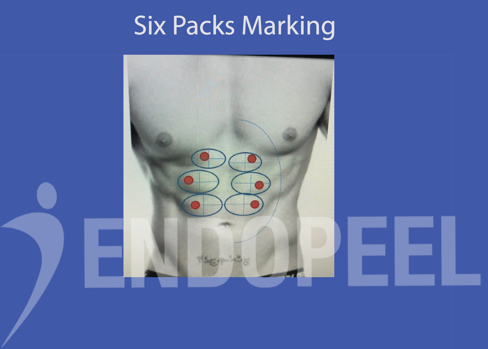 six packs marking