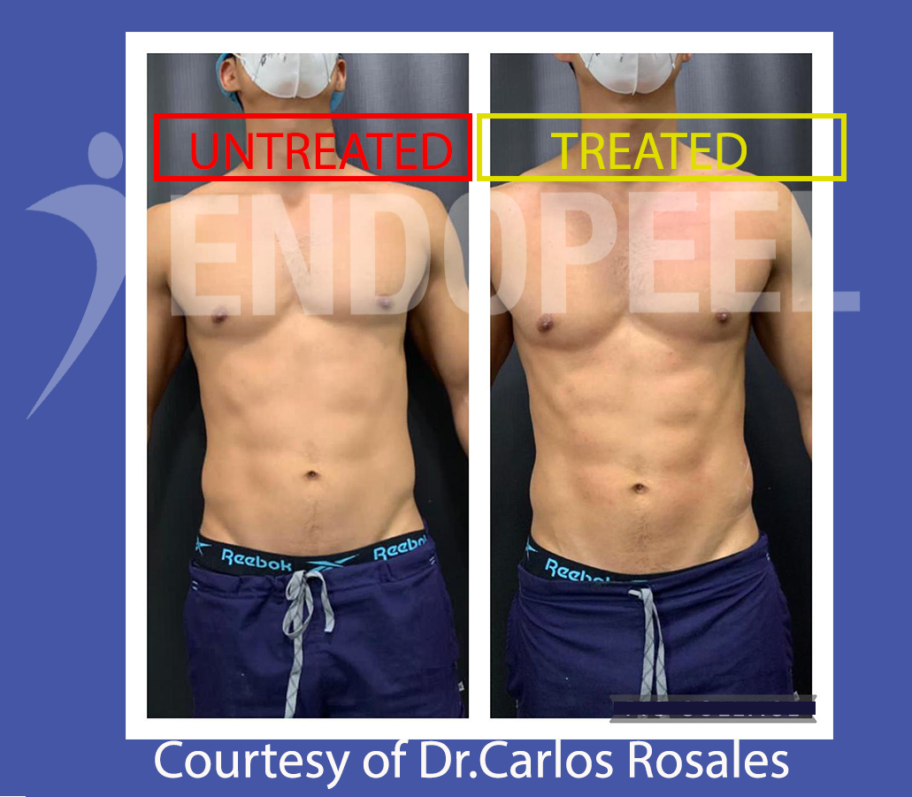 immediate 6 packs endopeel by Dr.Rosales front view