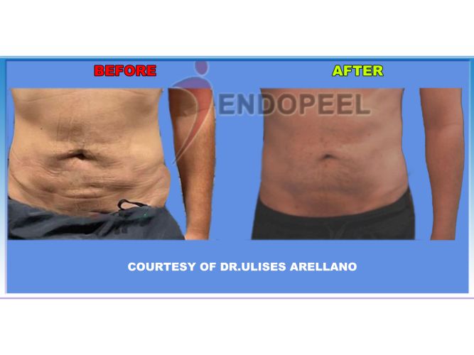 male-abdominopexy