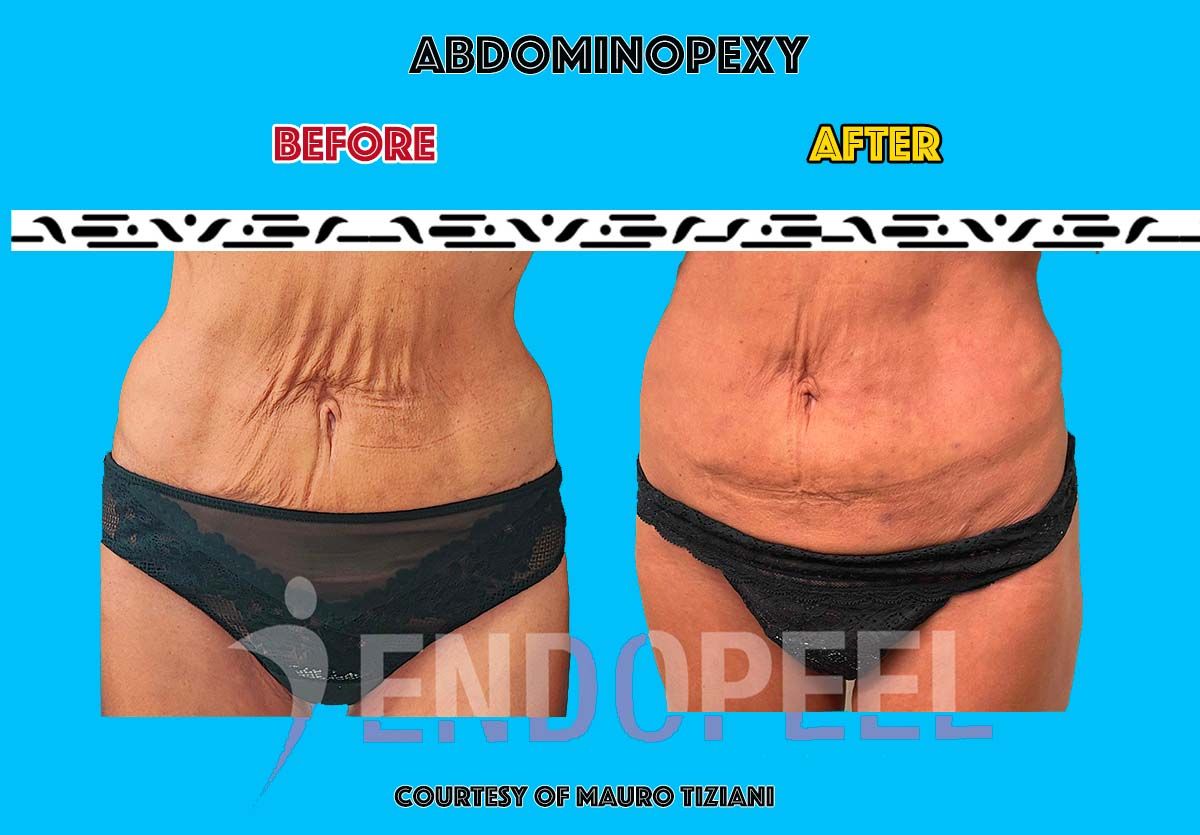 female abdominopexy 1st session