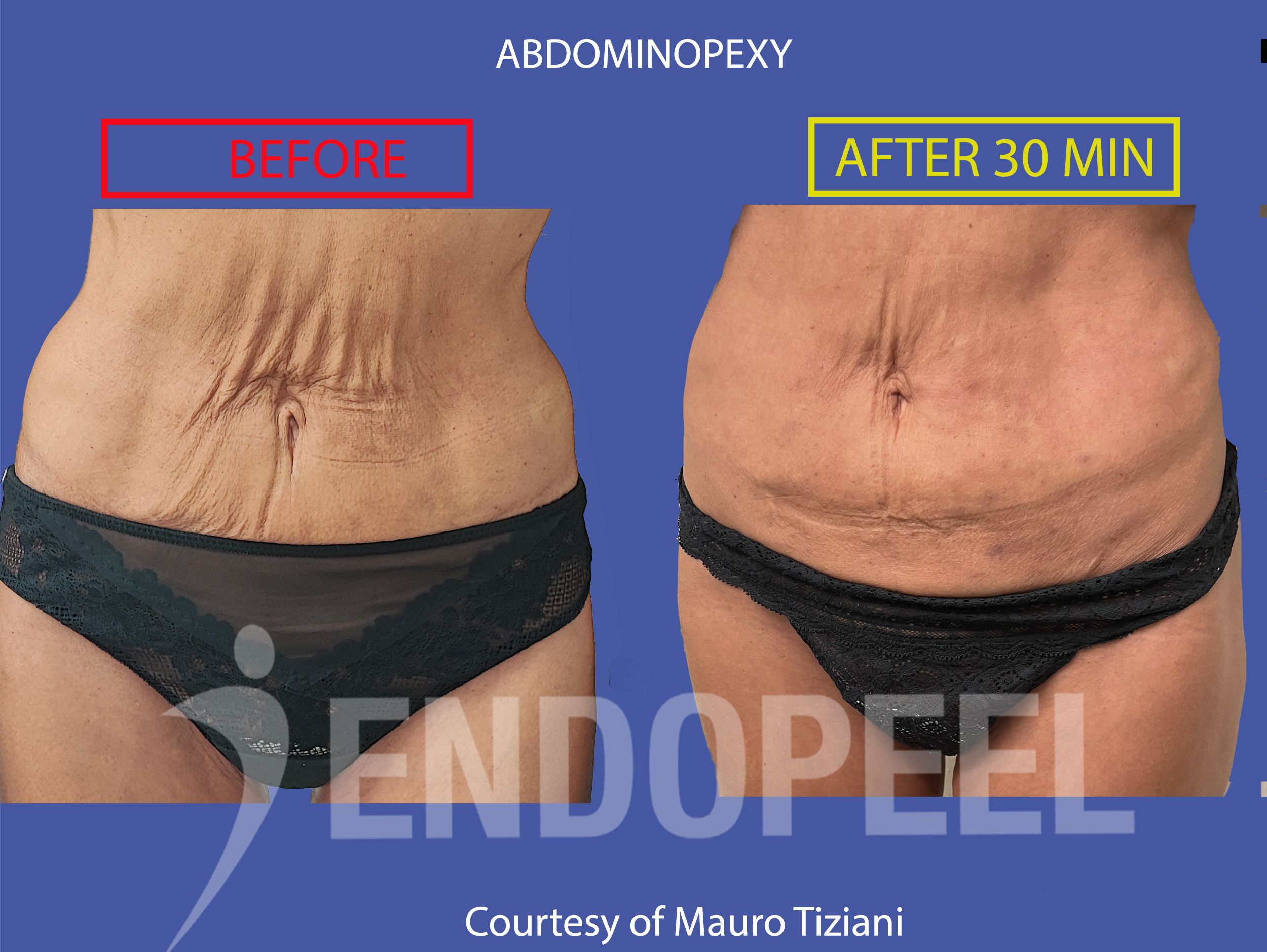 female abdominopexy 1st session