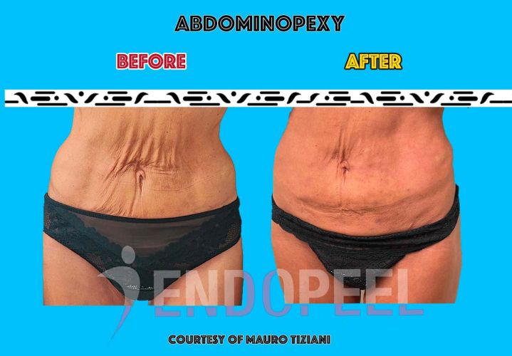 medical-abdominoplasty